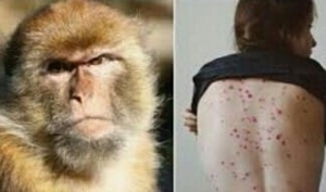 Oficial: Puebla registra dos casos positivos de viruela del mono